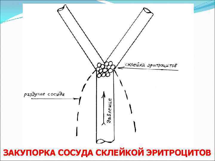 ЗАКУПОРКА СОСУДА СКЛЕЙКОЙ ЭРИТРОЦИТОВ 
