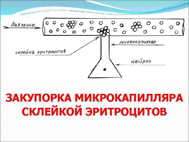 ЗАКУПОРКА МИКРОКАПИЛЛЯРА СКЛЕЙКОЙ ЭРИТРОЦИТОВ 