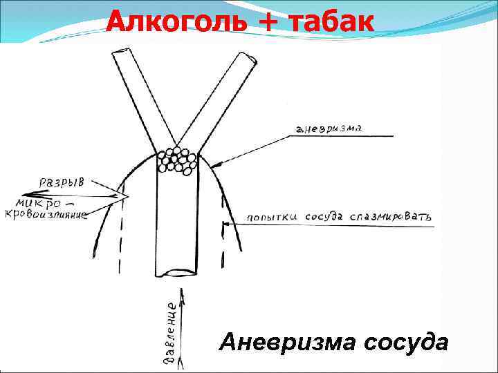 Алкоголь + табак Аневризма сосуда 
