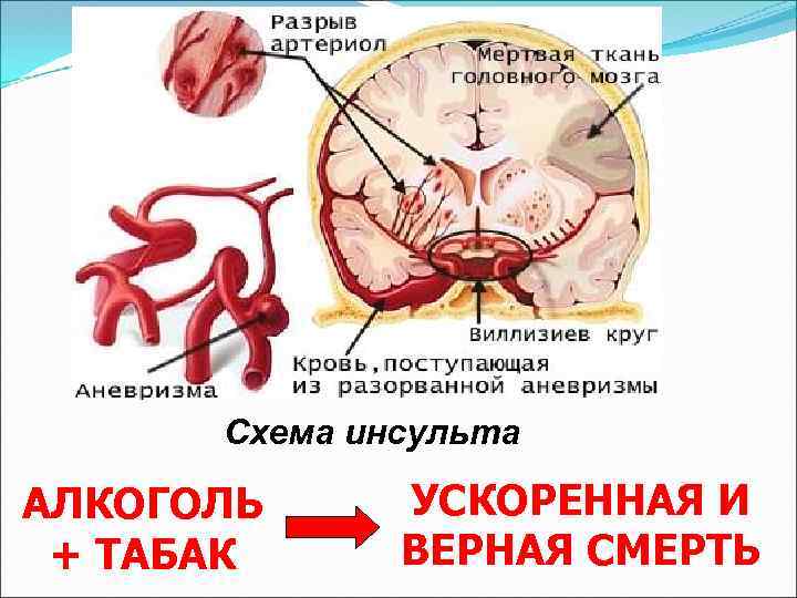 Схема инсульта АЛКОГОЛЬ + ТАБАК УСКОРЕННАЯ И ВЕРНАЯ СМЕРТЬ 