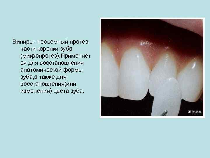 Виниры- несъемный протез части коронки зуба (микропротез). Применяет ся для восстановления анатомической формы зуба,