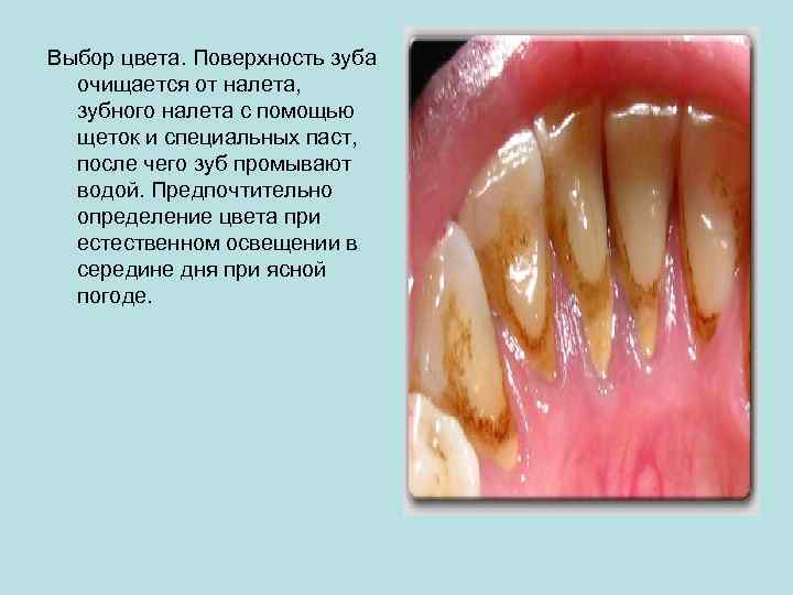 Выбор цвета. Поверхность зуба очищается от налета, зубного налета с помощью щеток и специальных