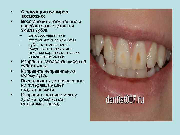  • • С помощью виниров возможно: Восстановить врожденные и приобретенные дефекты эмали зубов.