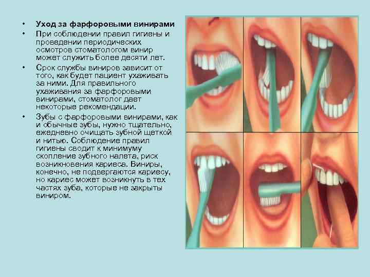  • • Уход за фарфоровыми винирами При соблюдении правил гигиены и проведении периодических