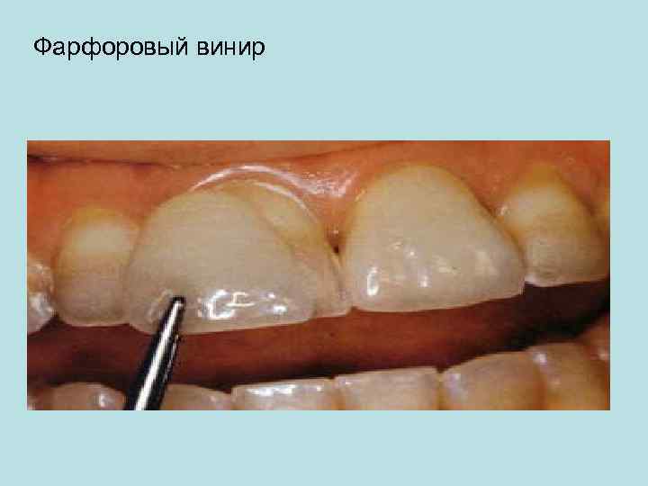 Фарфоровый винир 