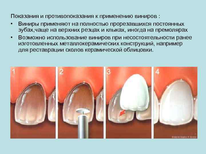 Показания и противопоказания к применению виниров : • Виниры применяют на полностью прорезавшихся постоянных