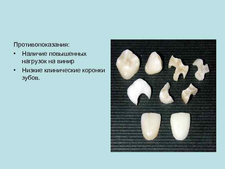 Противопоказания: • Наличие повышенных нагрузок на винир • Низкие клинические коронки зубов. 