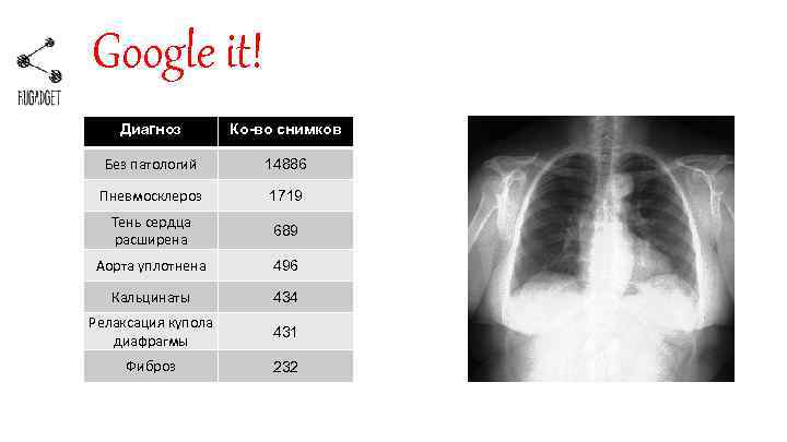 Google it! Диагноз Ко-во снимков Без патологий 14886 Пневмосклероз 1719 Тень сердца расширена 689
