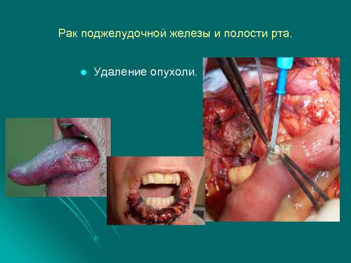 Рак поджелудочной железы и полости рта. l Удаление опухоли. 