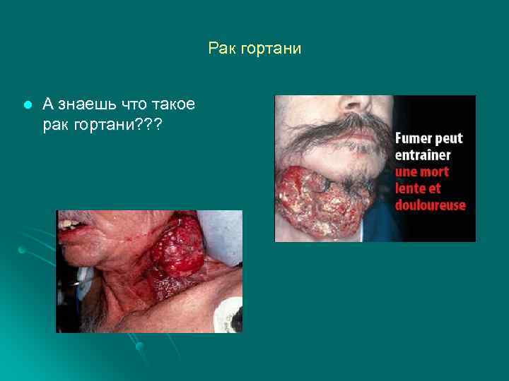 Рак гортани l А знаешь что такое рак гортани? ? ? 