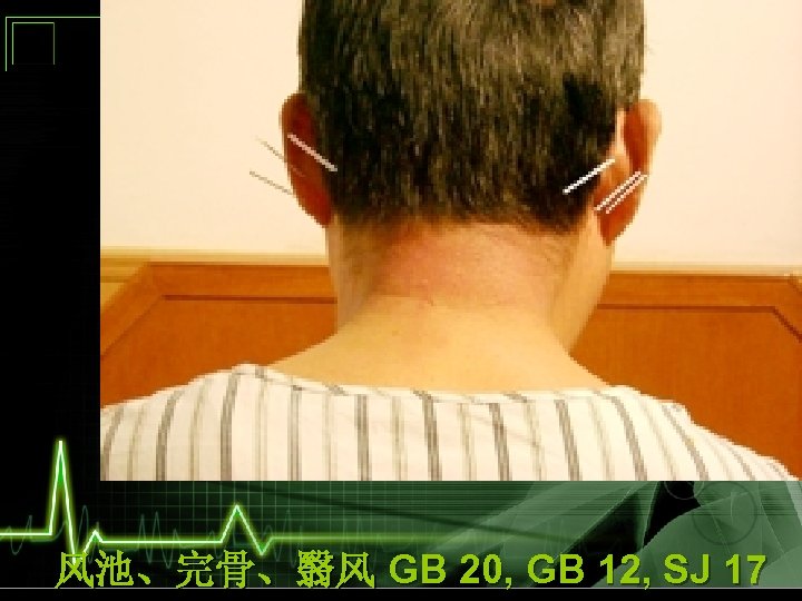 风池、完骨、翳风 GB 20, GB 12, SJ 17 