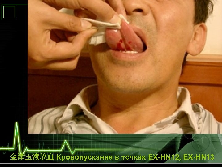 金津玉液放血 Кровопускание в точках EX-HN 12, EX-HN 13 