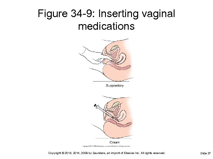 Figure 34 -9: Inserting vaginal medications Copyright © 2018, 2014, 2009 by Saunders, an
