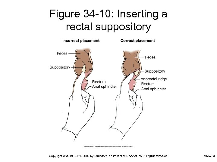Figure 34 -10: Inserting a rectal suppository Copyright © 2018, 2014, 2009 by Saunders,