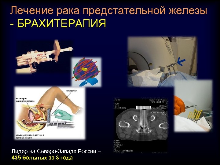 Лечение рака предстательной железы - БРАХИТЕРАПИЯ Лидер на Северо-Западе России – 435 больных за