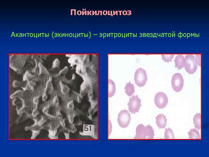 Пойкилоцитоз Акантоциты (эхиноциты) – эритроциты звездчатой формы 