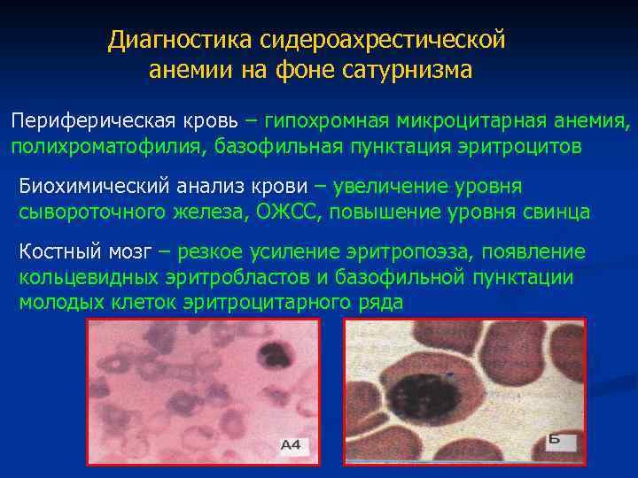 Диагностика сидероахрестической анемии на фоне сатурнизма Периферическая кровь – гипохромная микроцитарная анемия, полихроматофилия, базофильная