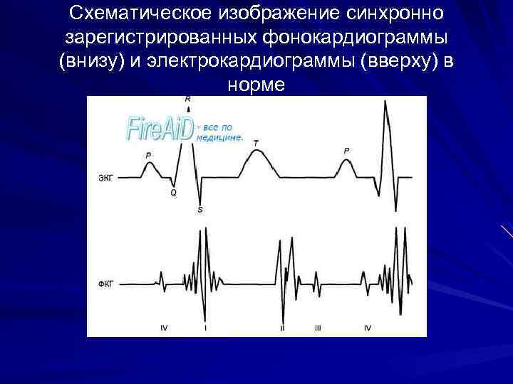 Графическое изображение тонов сердца