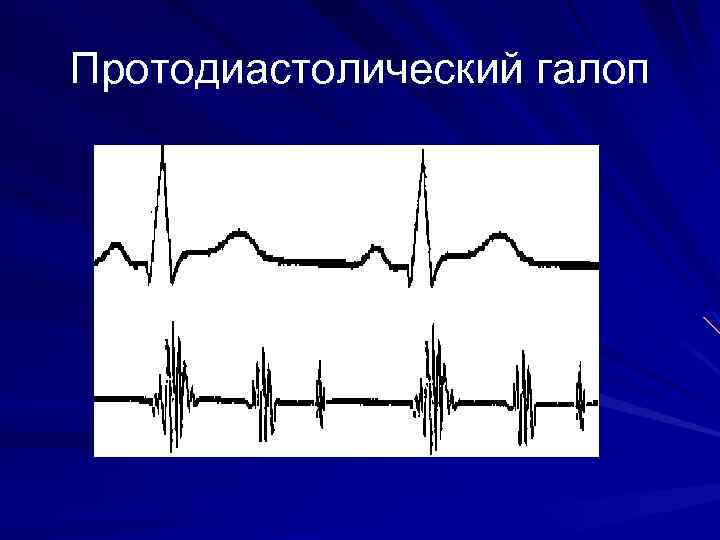 Графическое изображение тонов сердца