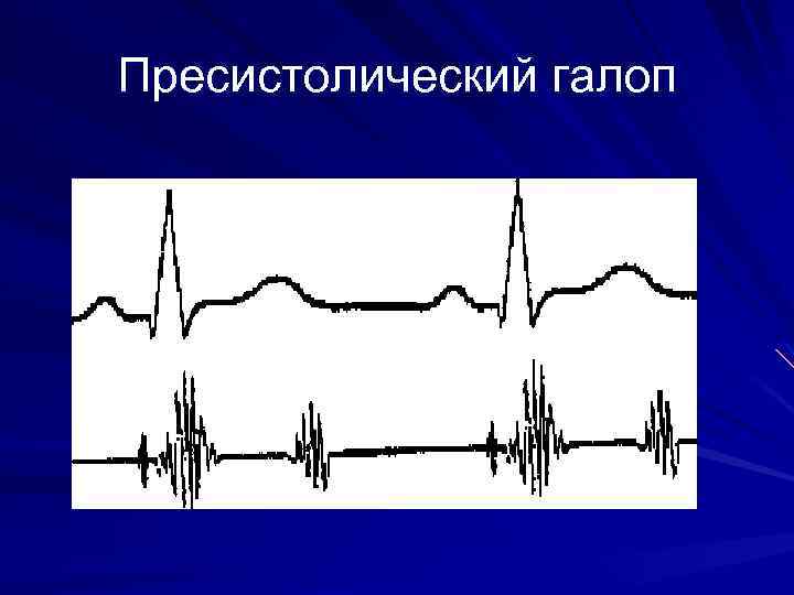 Ритм галопа. Протодиастолический ритм галопа схема. Мезодиастолический ритм галопа ФКГ. Фонокардиограмма ритма перепела. Ритм галопа на ЭКГ.