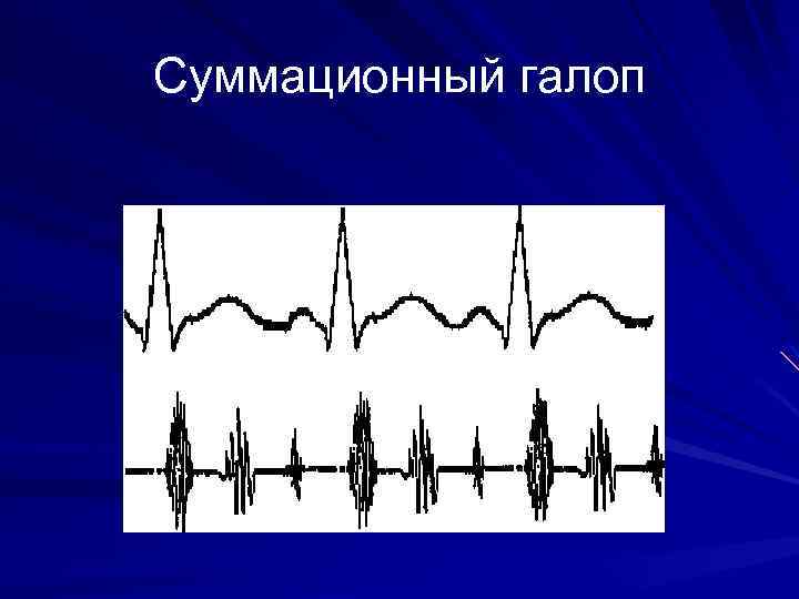 Графическое изображение тонов сердца