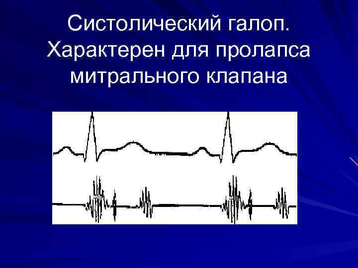 Систолический галоп. Характерен для пролапса митрального клапана 