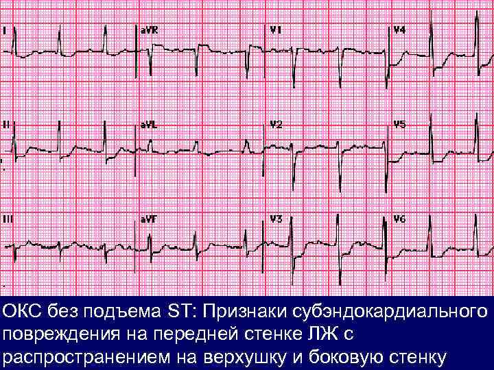 ОКС без подъема ST: Признаки субэндокардиального повреждения на передней стенке ЛЖ с распространением на