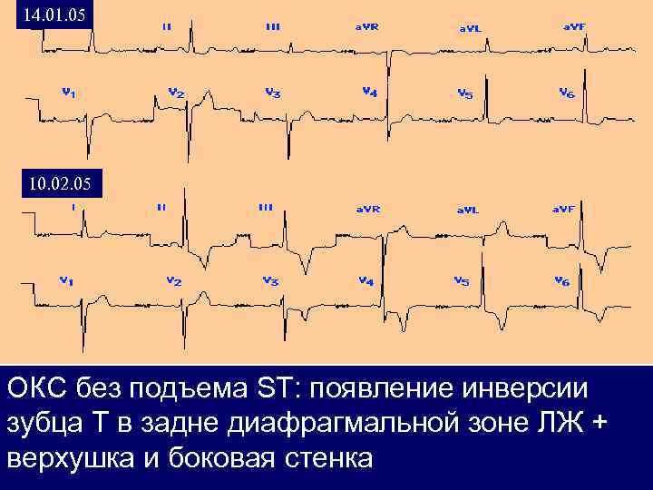 Окс без подъема st на экг