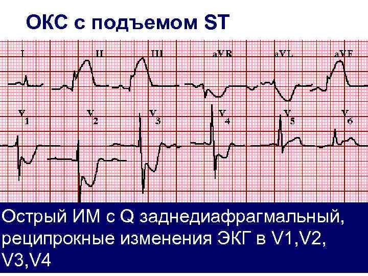 Экг синдромы при окс