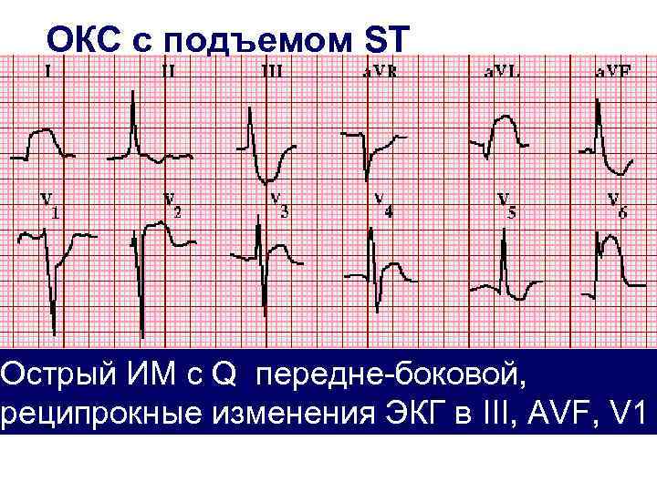 Экг при окс презентация