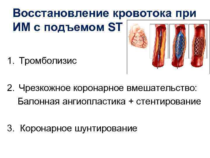 Восстановление кровотока при ИМ с подъемом ST 1. Тромболизис 2. Чрезкожное коронарное вмешательство: Балонная
