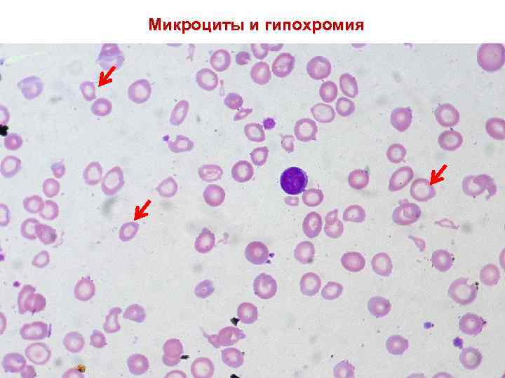 Микроциты и гипохромия 