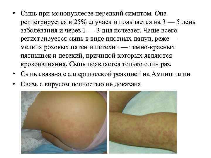  • Сыпь при мононуклеозе нередкий симптом. Она регистрируется в 25% случаев и появляется