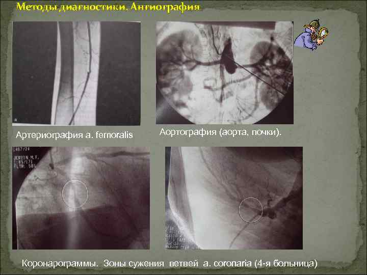 Методы диагностики. Ангиография Артериография a. femoralis Аортография (аорта, почки). Коронарограммы. Зоны сужения ветвей a.