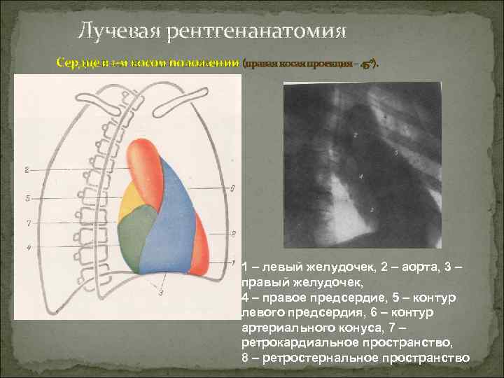  Лучевая рентгенанатомия Сердце в 1 -м косом положении (правая косая проекция – 45