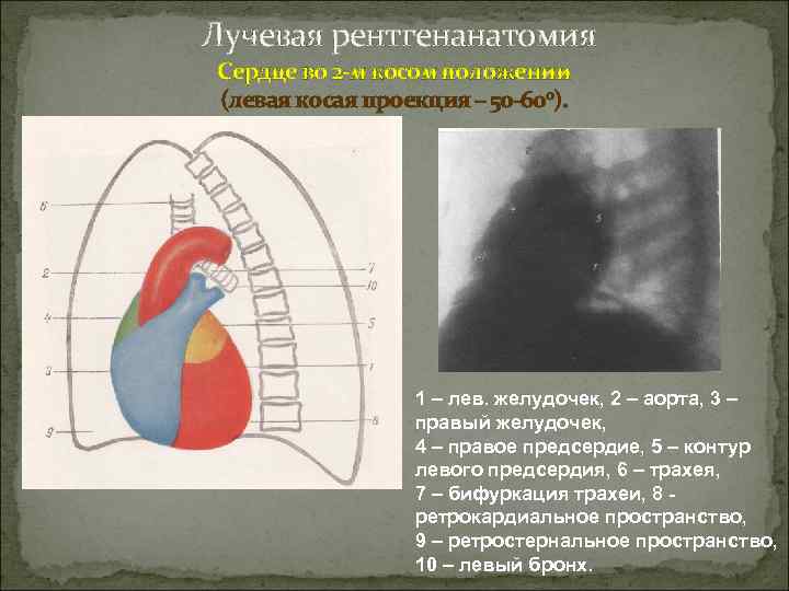  Лучевая рентгенанатомия Сердце во 2 -м косом положении (левая косая проекция – 50