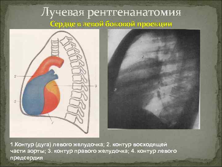 Лучевая рентгенанатомия Сердце в левой боковой проекции 1. Контур (дуга) левого желудочка; 2. контур