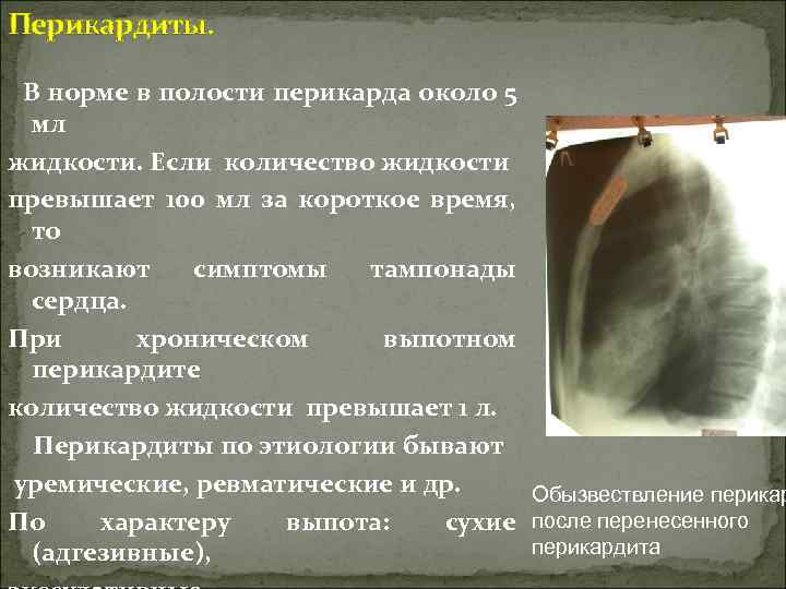 Перикардиты. В норме в полости перикарда около 5 мл жидкости. Если количество жидкости превышает