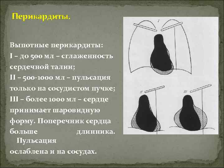 Перикардиты. Выпотные перикардиты: I – до 500 мл – сглаженность сердечной талии; II –