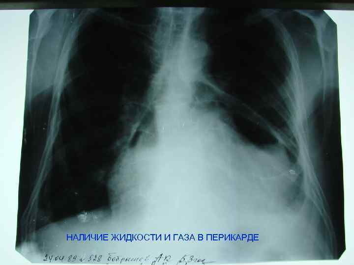 НАЛИЧИЕ ЖИДКОСТИ И ГАЗА В ПЕРИКАРДЕ 