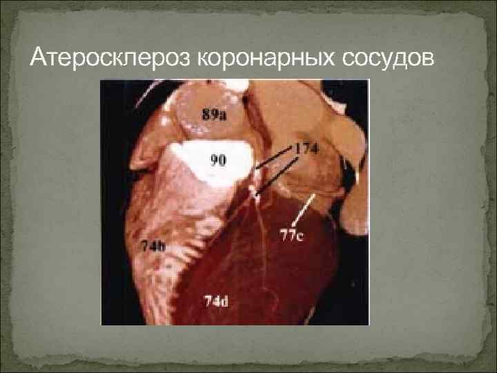 Атеросклероз коронарных сосудов 