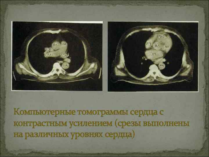 Компьютерные томограммы сердца с контрастным усилением (срезы выполнены на различных уровнях сердца) 