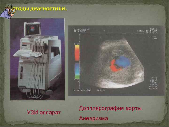 Методы диагностики. УЗИ аппарат Допплерография аорты. Аневризма 