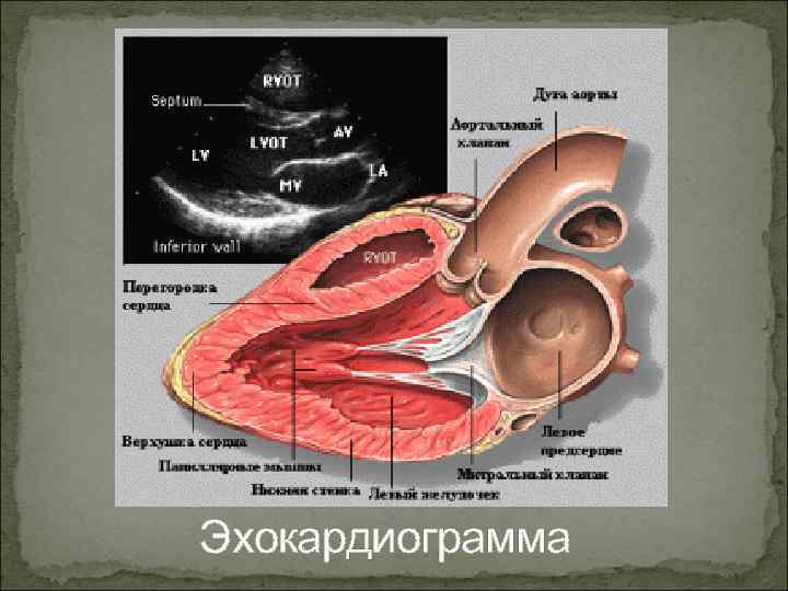 Эхокардиограмма 