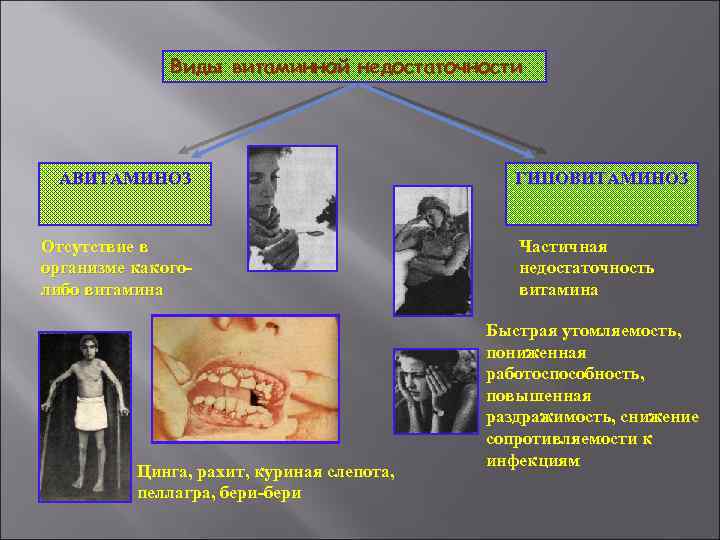 Виды витаминной недостаточности АВИТАМИНОЗ Отсутствие в организме какоголибо витамина Цинга, рахит, куриная слепота, пеллагра,