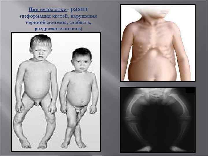 При недостатке - рахит (деформация костей, нарушения нервной системы, слабость, раздражительность) 