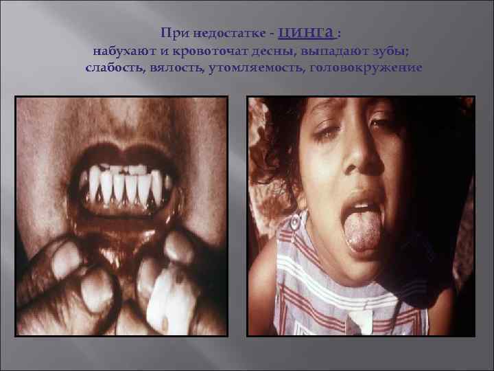 При недостатке - цинга : набухают и кровоточат десны, выпадают зубы; слабость, вялость, утомляемость,