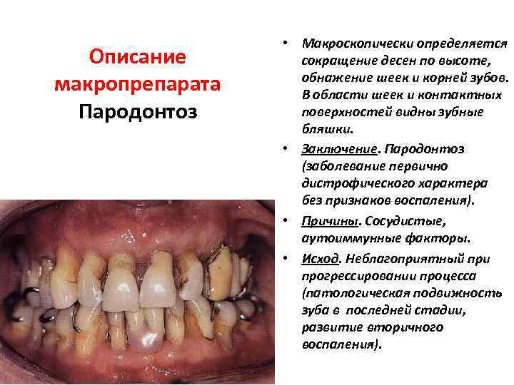 Описание макропрепарата Пародонтоз • Макроскопически определяется сокращение десен по высоте, обнажение шеек и корней