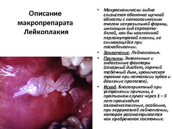 Описание макропрепарата Лейкоплакия • Макроскопически видна слизистая оболочка щечной области с патологическим очагом неправильной