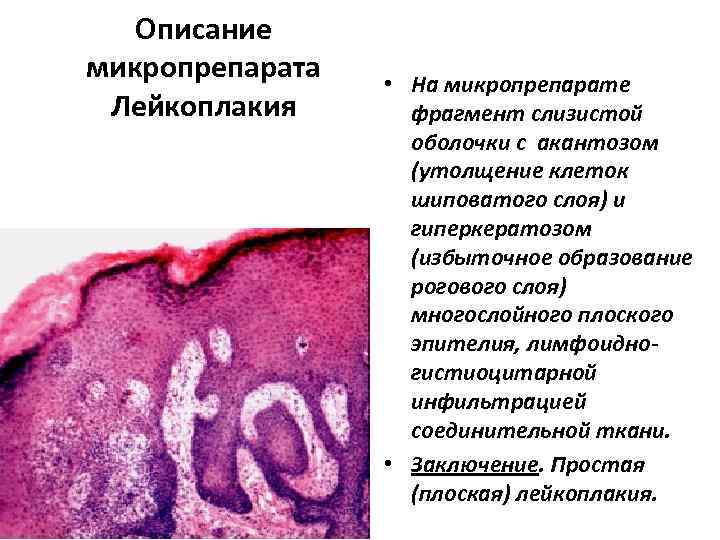 Описание микропрепарата Лейкоплакия • На микропрепарате фрагмент слизистой оболочки с акантозом (утолщение клеток шиповатого